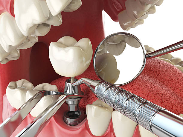 Best Broken or Chipped Tooth Repair in Whitehall, MI