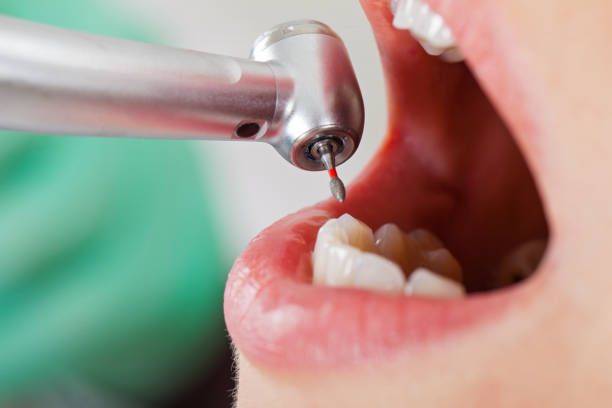 Best Knocked-Out Tooth (Avulsed Tooth) Treatment in Whitehall, MI